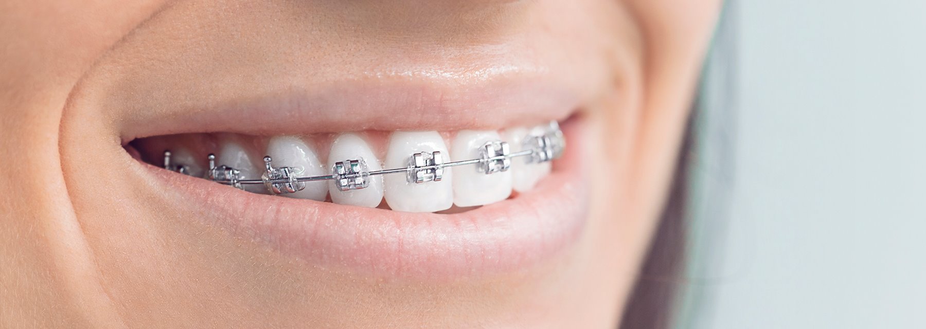 Indirect Bonding - Gibb Orthodontics, Lethbridge, AB T1K
