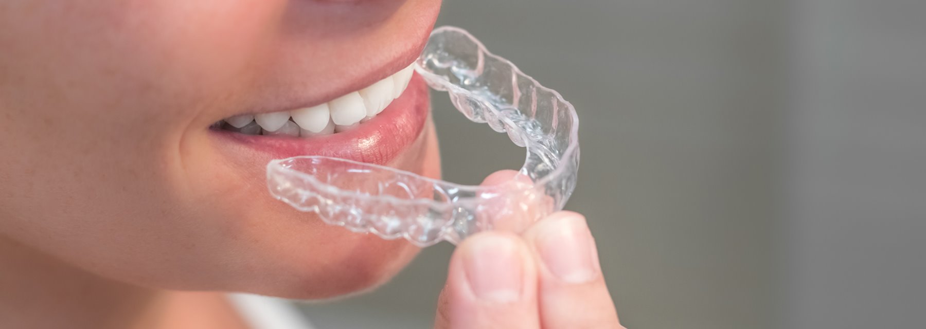 Invisalign treatment - Gibb Orthodontics, Lethbridge, AB T1K