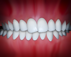 malocclusion.png