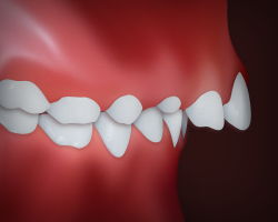 underbite.png